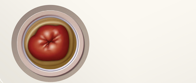 a cartoon drawing of a stoma