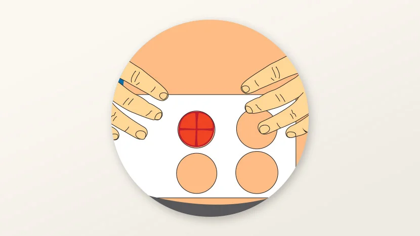 Illustration of stoma